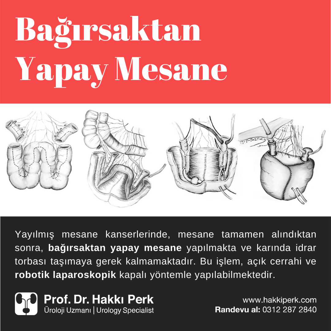 Yayılmış Mesane Kanseri (Yapay Mesane)
