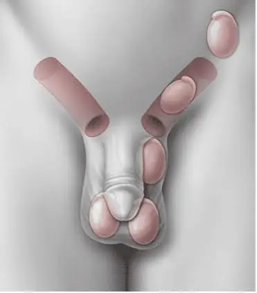 İnmemiş Testis