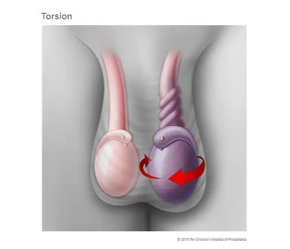 Testis Torsiyonu